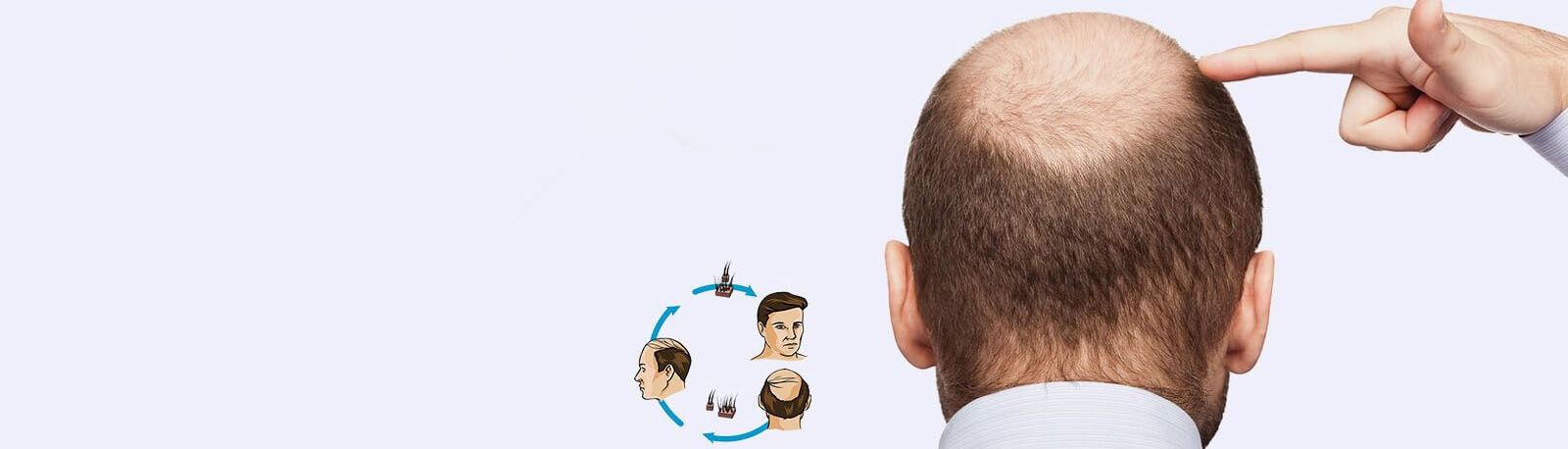 Dr Dutt Hair Transplant Center For Best Hair Transplant in Delhi